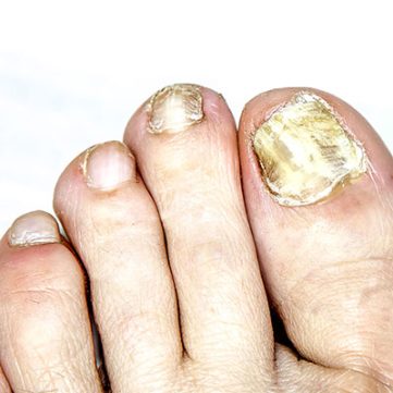 Pedikura-glivice-onychomycosis